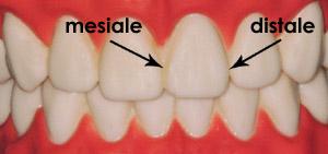 lato-mesiale-distale-denti